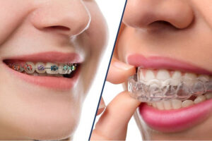 So Sánh Răng Sứ Thẩm Mỹ Và Chỉnh Nha, Loại Nào Tốt Hơn?