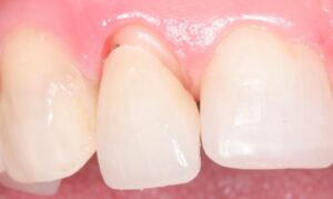 Điều trị răng sứ bị tụt nướu