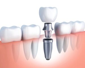 Làm thế nào để tăng độ bền của trồng răng implant