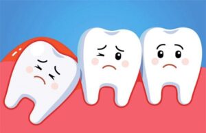 Lợi ích của việc cắt lợi trùm răng khôn
