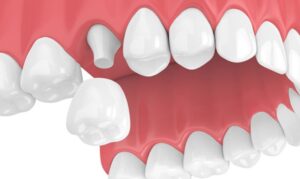 Lợi ích của việc chải răng đúng cách