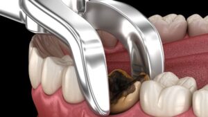 Quy trình trám răng số 6 bị sâu