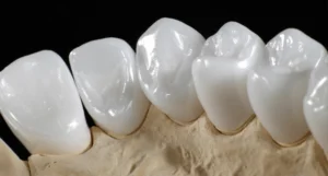Răng Sứ Zirconia Có Tốt Không? Lợi Ích Và Những Điều Cần Lưu Ý