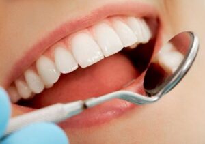 Răng Sứ Cercon Là Gì? Chất Liệu Và Lợi Ích Của Răng Sứ Cercon